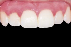 Prophylaxe / Dentalhygiene 70
