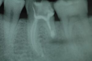 Zahn 36 nach der Entfernung der Wurzelspitze und Verschluss