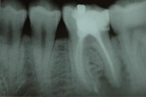 Zahn 36 distal ist wurzelbehandelt und hat am hinteren Wurzelspitzen eine Entzündung