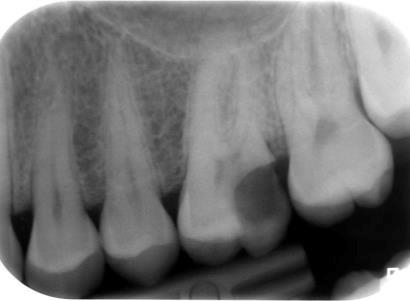 Wurzelbehandlung - Zahnarzt am Albisriederplatz